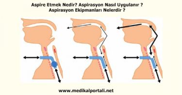 aspire-etmek-nedir-aspirasyon-nasil-uygulanir-aspirasyon-ekipmanlari-nelerdir