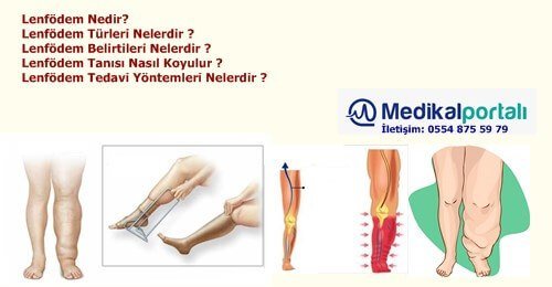 lenfodem-nedir-turleri-belirtileri-nedenleri-nelerdir-neden-olur-nasil-tedavi-edilir-yontemleri-riskleri-nelerdir-birincil-ikincil-primer-ayakta-lenfodem