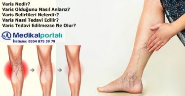 varis-nedir-kimlerde-gorulur-niye-olur-nelerdir-tedavi-yontemleri-varikoz-damar-orumcek-damar-sebepleri-iyilesirmi