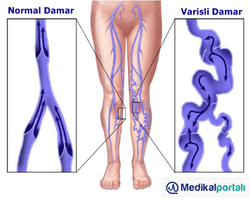 Varis Nedir? Varis Olduğunu Nasıl Anlarız ? Varis Nasıl Tedavi Edilir ? 2 varis-nedir-neden-olur-nasil-baslar-gecer-anlasilir-belirtileri-yan-etkileri-nelerdir