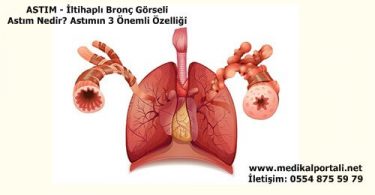astim-bronsit-nedir-neden-olur-nedenleri-belirtileri-nelerdir-nasil-tedavi-edilir