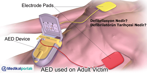 Defibrilatör Nedir? Defibrilasyon Nedir? Ne İşe Yarar, Tarihçesi Nedir? 2 defibrilasyon-nedir-ne-zaman-uygulanir-kimlere-nasil-yapilir-kullanilir-defibrilatorun-amaci-nedir