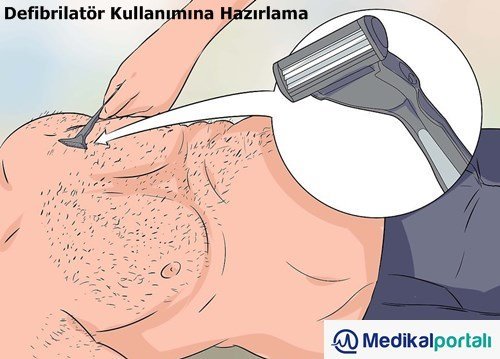 Defibrilatör Nasıl Kullanılır? Uygulama Aşamaları Nelerdir? 7 defibrilator-kullanimina-hazirlama-islemi-nasil-yapilir-hastaya-hangi-uygulama-yapilmalidir