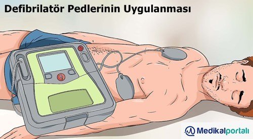 Defibrilatör Nasıl Kullanılır? Uygulama Aşamaları Nelerdir? 8 defibrilator-pedleri-nasil-uygulanir-takilirken-nelere-dikkat-edilmelidir-yetiskin-pediatrik-pedleri