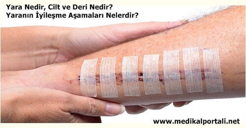 yara-nedir-dokusu-irrigasyonu-enfeksiyonu-bakimi-acilmasi-asamalari-cesitleri-nelerdir