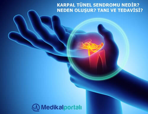el-bilek-hastaligi-karpal-tunel-sendromu-nedir-medikal-tedavisi-tekrarlarmi-nasil-anlasilir-belirtileri-ne-kadar-zamanda-iyilesir