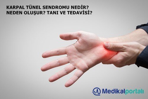 karpal-tunel-sendromu-bulgulari-baslangici-el-bileklik-turleri-basparmak-bilek-agrisi-kimlerde-gorulur-kendiliginden-gecermi-nasil-gecer