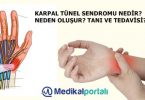 karpal-tunel-sendromu-nedir-meslek-hastaligi-belirtileri-nelerdir-neden-olusur-tedavisi-el-bilek-hastaligi