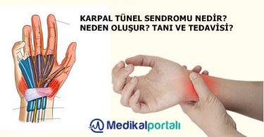karpal-tunel-sendromu-nedir-meslek-hastaligi-belirtileri-nelerdir-neden-olusur-tedavisi-el-bilek-hastaligi