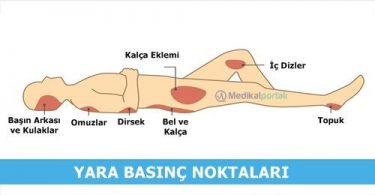 basi-yarasi-nedir-neden-olusur-asamalari-iyilesme-evreleri-tani-tedavi-yontemleri-basinc-noktalari-nelerdir-yatak-yarasi-pansumani-nasil-yapilir-iyilesirmi