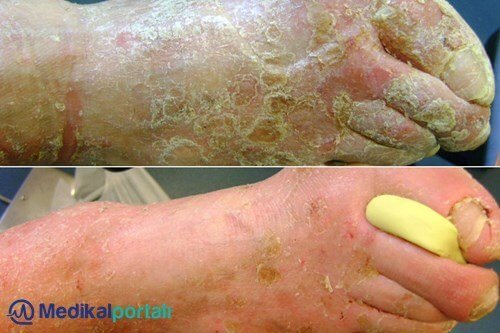 Lohmann Rauscher Debrisoft Debridman Pad 2 debridman-ne-demek-nasil-yapilir-debridman-pedi-nasil-satin-alinir-kullanilir-yara-bakiminda-uygulama-yontemleri