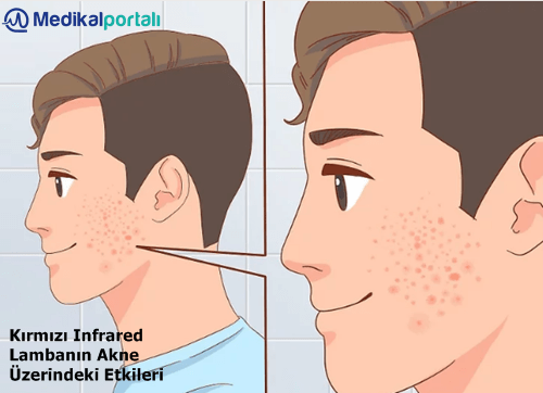 kirmizi-infrared-isiticili-led-lambanin-akne-hastaliklari-uzerindeki-etkileri-nelerdir-nasil-tedavi-edilir-uygulanir-fototerapi-faydalari