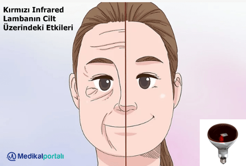 kirmizi-infrared-isiticili-led-lambanin-cilt-hastaliklari-uzerindeki-etkileri-nelerdir-nasil-tedavi-edilir-uygulanir-fototerapi-faydalari