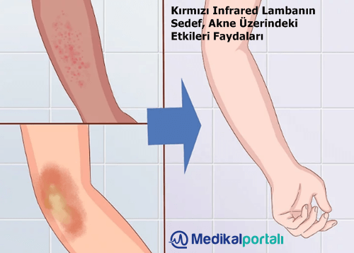 kirmizi-infrared-isiticili-led-lambanin-cilt-sedef-akne-hastaliklari-uzerindeki-etkileri-nelerdir-nasil-tedavi-edilir-uygulanir-fototerapi-faydalari
