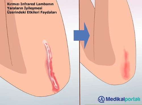 kirmizi-infrared-isiticili-led-lambanin-yaralarin-iyilesmesi-uzerindeki-etkileri-nelerdir-nasil-tedavi-edilir-uygulanir-fototerapi-faydalari