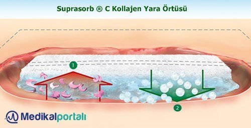 Suprasorb ® C Kollajen Yara Örtüsü 3 kollajen-yara-ortusu-suprasorb-c-urun-ozellikleri-ne-ise-yarar-nasil-nerede-kullanilir-uygulamasi-satin-alinir-fiyatlari