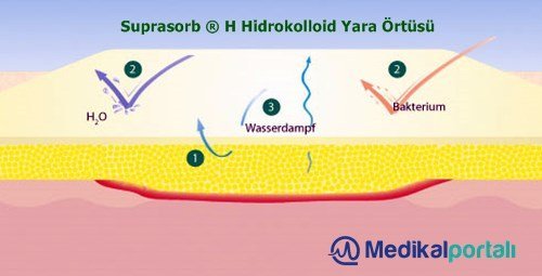 modern-yara-bakim-ortuleri-hidrokolloid-suprasorb-h-nedir-ne-ise-yarar-neden-nasil-kullanilir-fiyatlari