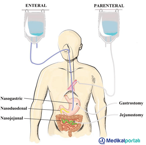 Enteral Beslenme Nedir, Mama Torbası Türleri Nelerdir? 2