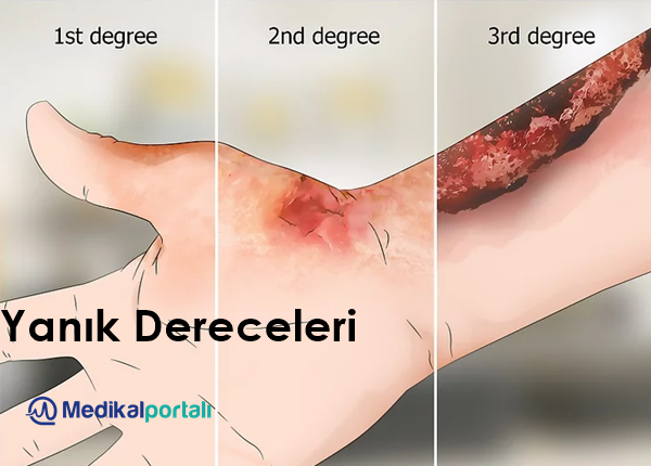 Yanık Seti Nedir, Ne İşe Yarar? 6