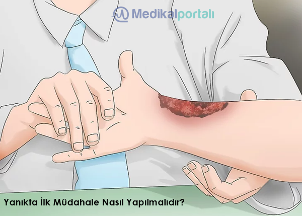 Yanık Seti Nedir, Ne İşe Yarar? 2